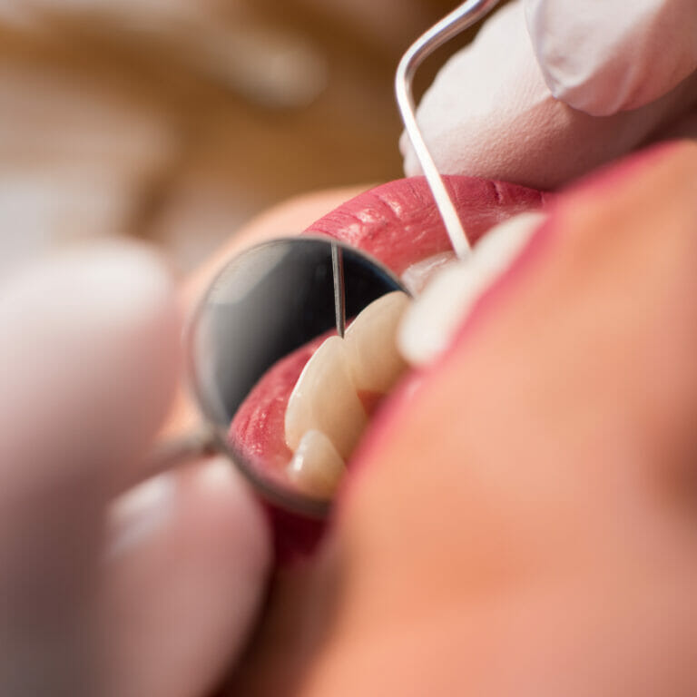 Macro shot of girl having dental check up in dental clinic. Dentist examining a patient's teeth